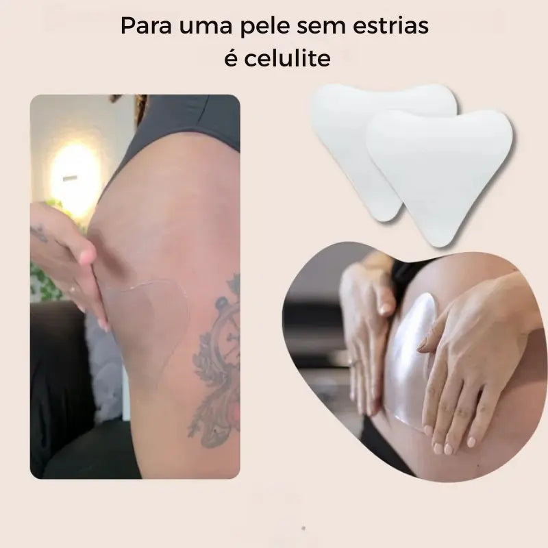 Plaquinha de oclusão 90 dias sem estrias