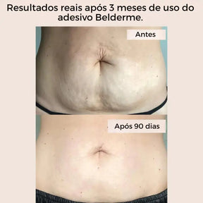 Plaquinha de oclusão 90 dias sem estrias