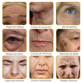 BotoxBee® | Pareça 15 anos mais jovem em apenas 3 minutos!